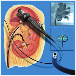 Holmium Laser Treatment