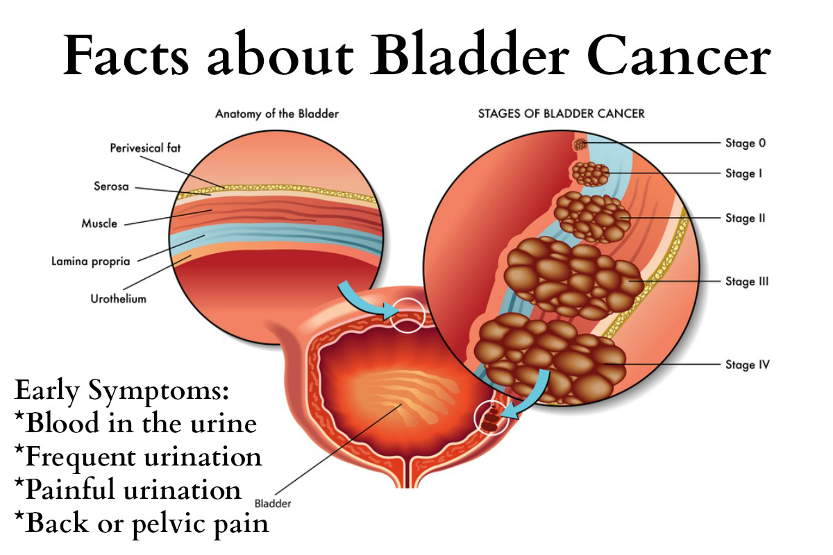 Prostate  Treatment