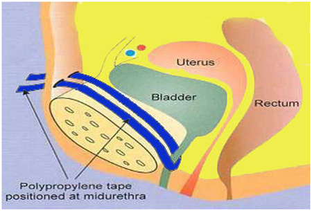 FEMALE INCONTINENCE SURGERY 