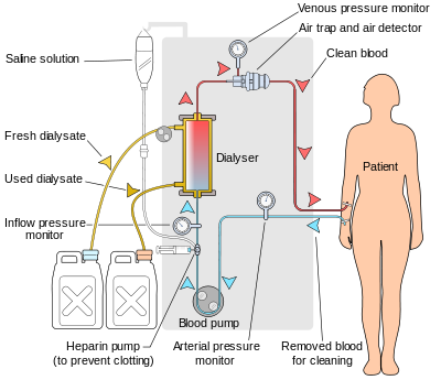 Hemodialysis  Treatment