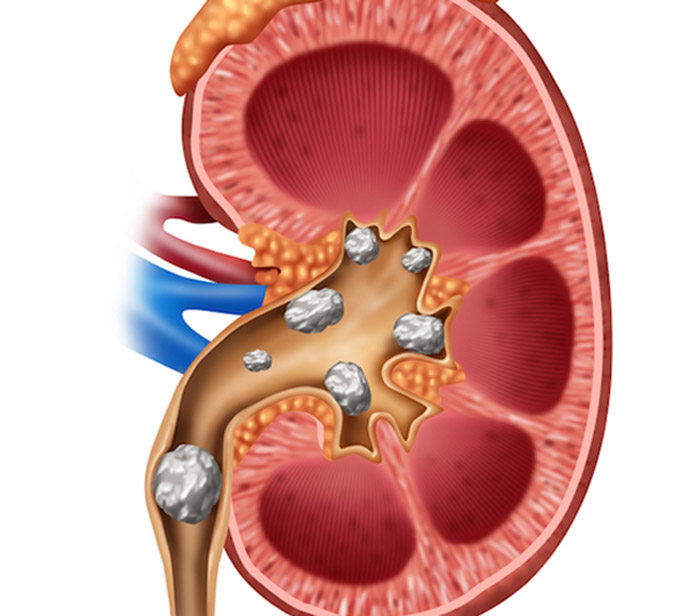 Kidney stone Specialist in Daulatpur