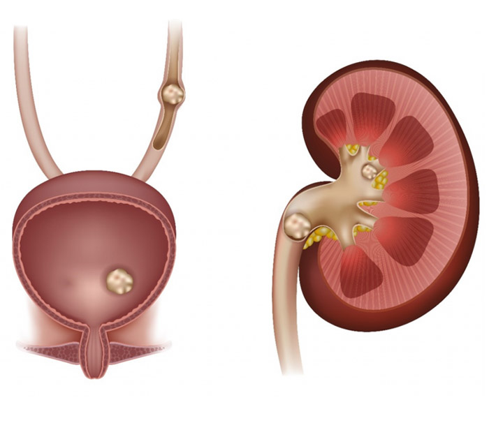 Kidney stone Specialist in Jawalamukhi