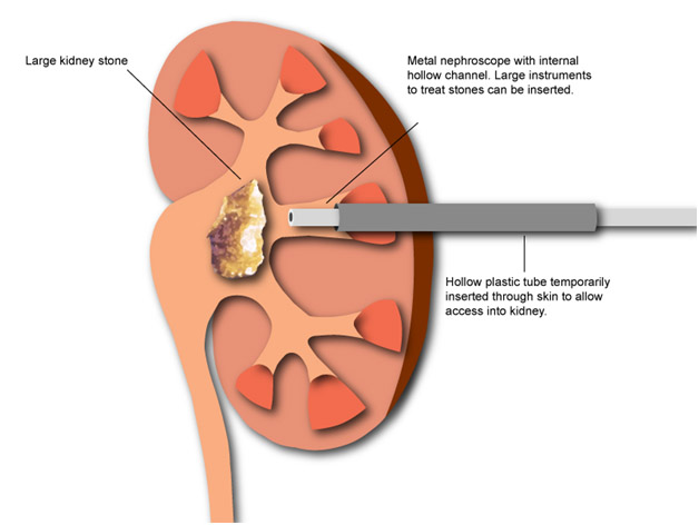 RIRS MINI MICRO PCNL