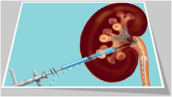 RIRS MINI MICRO PCNL