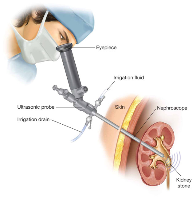 RIRS MINI MICRO PCNL