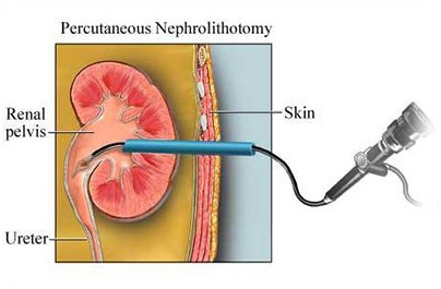 RIRS MINI MICRO PCNL