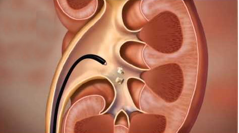 RIRS MINI MICRO PCNL