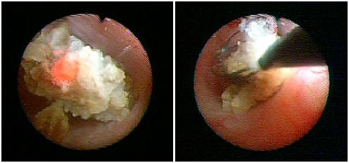 RIRS MINI MICRO PCNL