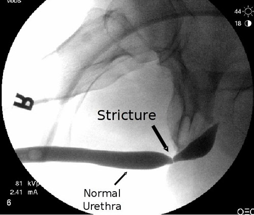 Reconstructive Urology 