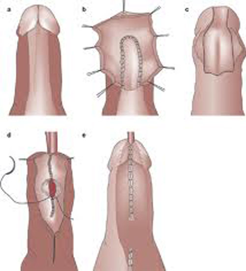 Laparoscopic Urology 