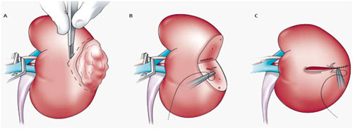 Uro-oncology (Cancer of Prostate, Kidney & Bladder) 